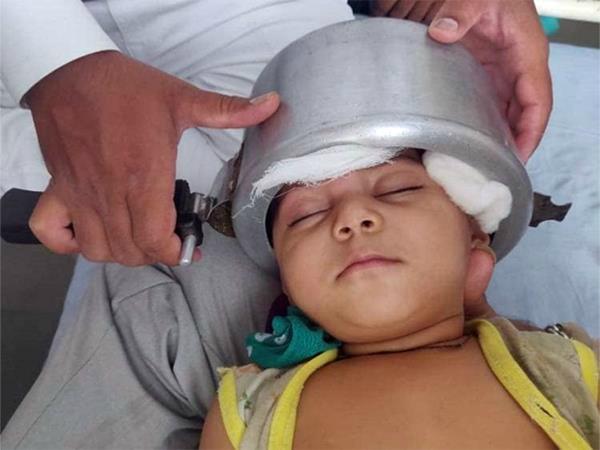 कुकर में फंसा 1 साल की बच्ची का सिर, डॉक्टर भी हुए फेल…45 मिनट बाद ऐसे निकाला बाहर