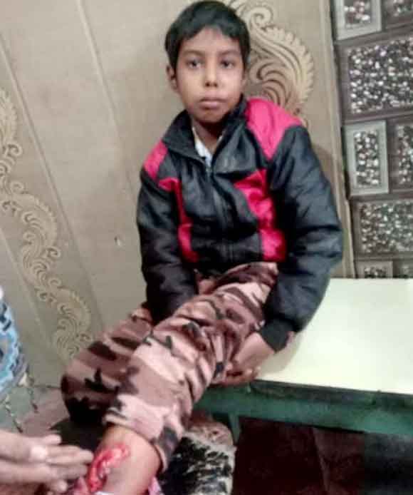 पालतू कुत्ते के नोच खाने से आठ वर्षीय बालक हुआ गंभीर घायल -परिजनो व पुलिस द्वारा उपचार के लिए सीएचसी में किया भर्ती