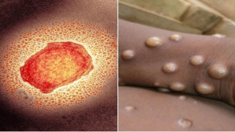 पटना में मिली मंकीपाक्‍स की संदिग्‍ध महिला मरीज, बिहार में एहतियाती गाइडलाइन जारी