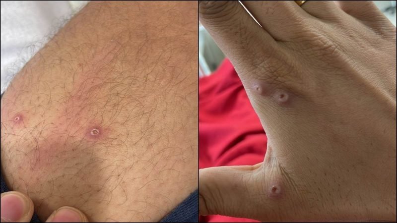 मंकीपाक्स का एक और संदिग्ध मरीज मिला, LNJP अस्पताल में चल रहा इलाज; दो महीने पहले पेरिस से लौटा था शख्स